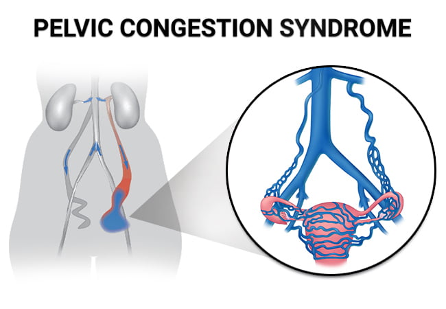 Pelvic Congestion Syndrome