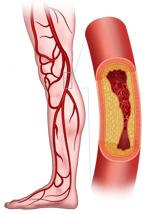 Peripheral Arterial Disease