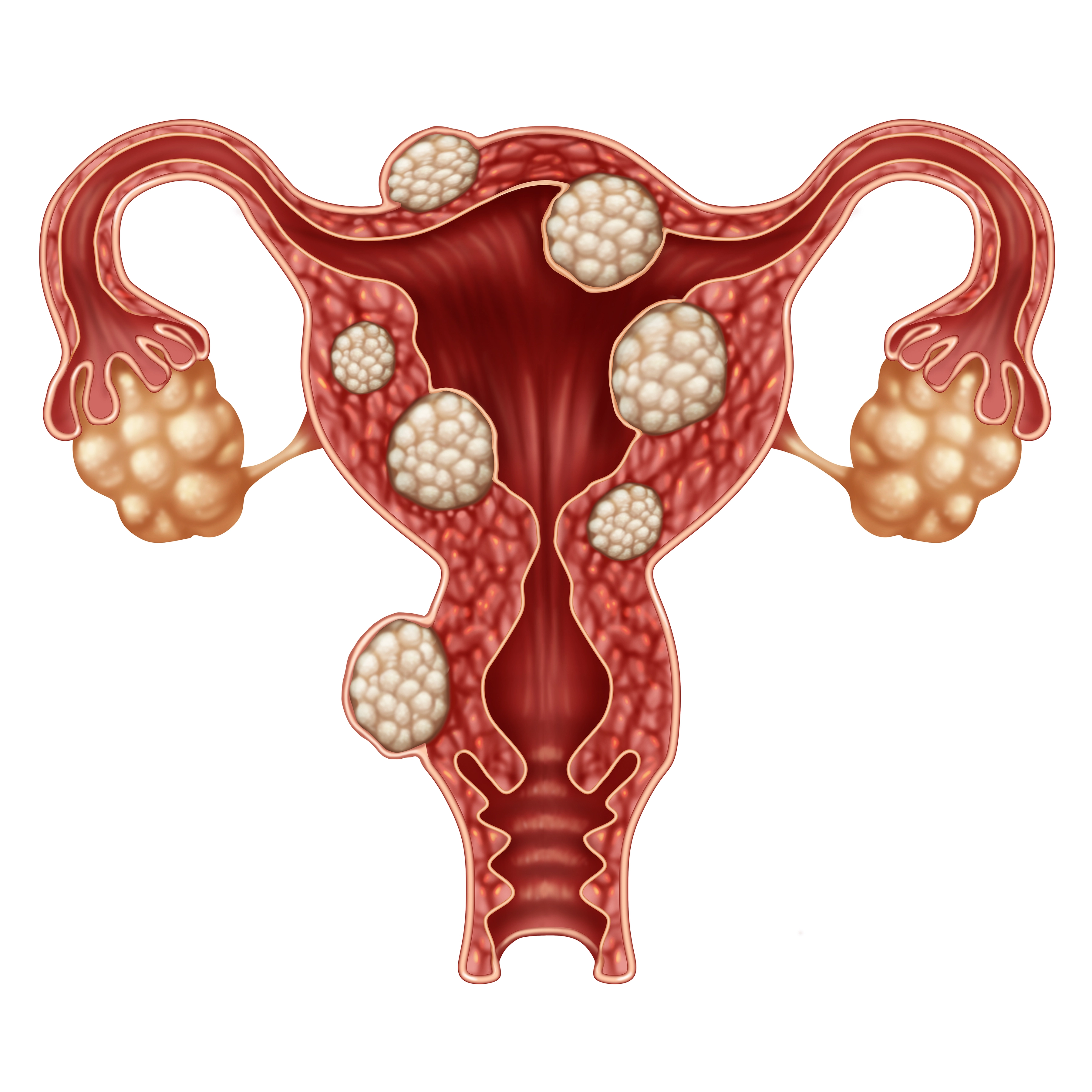 Fibroid Embolization