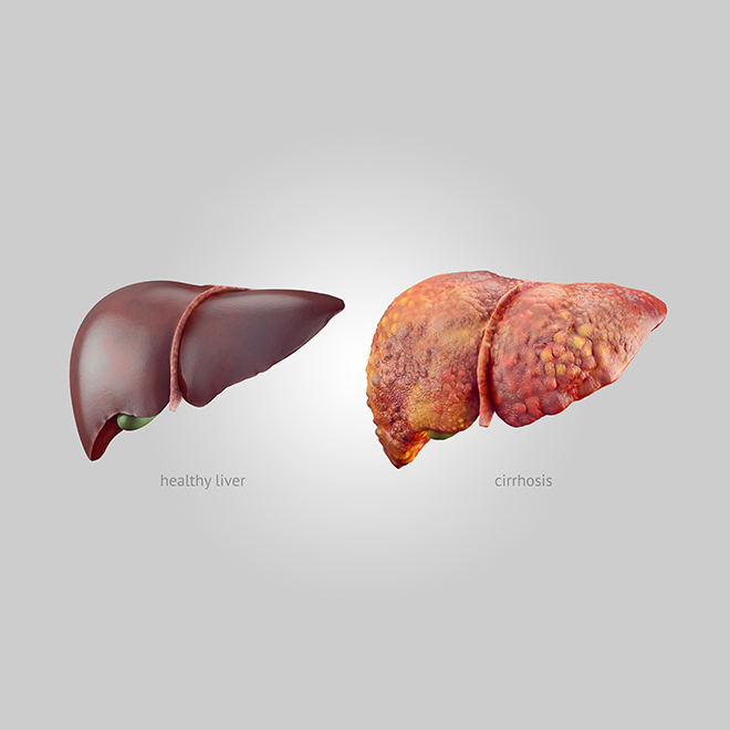 Liver Cirrhosis