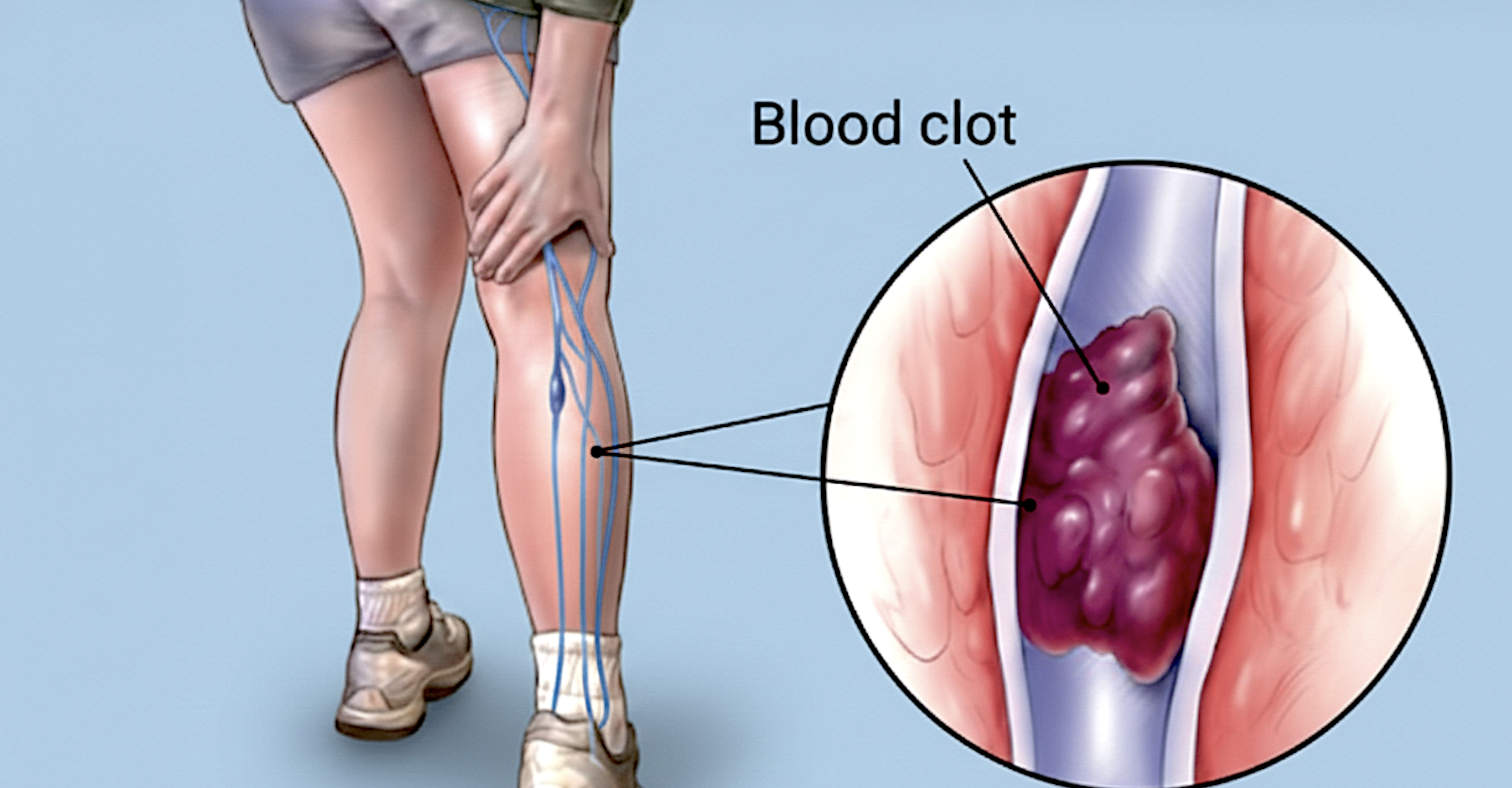 Venous Thromboembolism diagram showing blood clot in deep veins