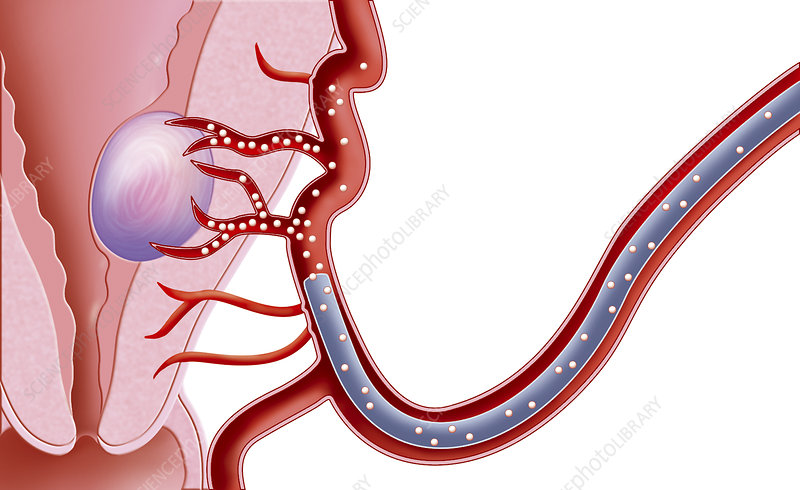 Uterine Fibroid Embolization (UFE)