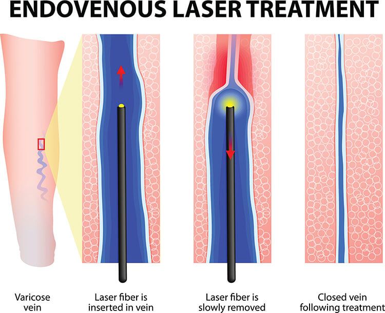 EVLA Treatment Procedure